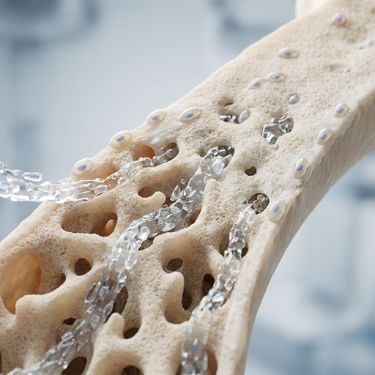 Bone Remineralisation